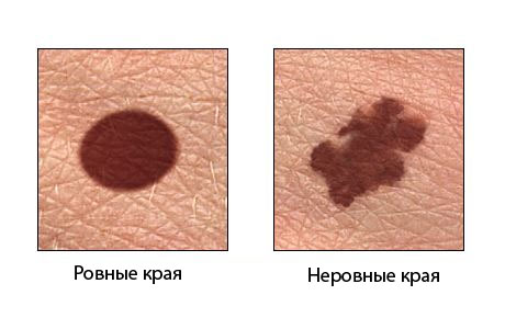 Меланома – это самый опасный вид рака кожи. Узнайте о нем.